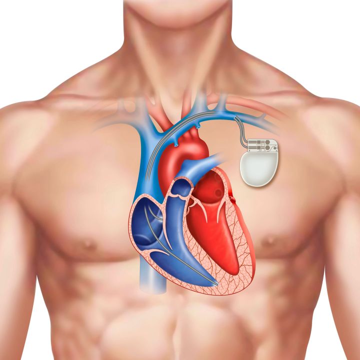 Cardiologie: le Maroc entre dans l'ère du pacemaker 2.0 - Sciences & Santé -
                    Luxe radio