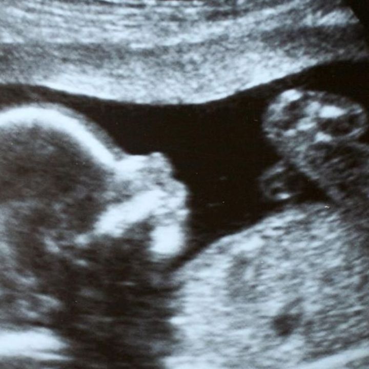 Trisomie 21 : le gouvernement ne veut pas rembourser le test prénatal ! - Avec Ou Sans Parure -
                    Luxe radio