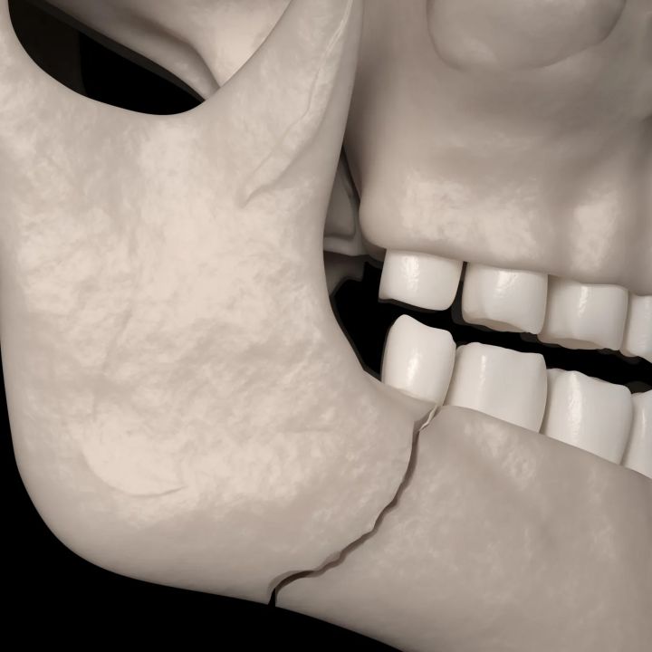« Bone smashing » ou la fausse promesse d’un visage remodelé. - Sciences & Santé -
                    Luxe radio