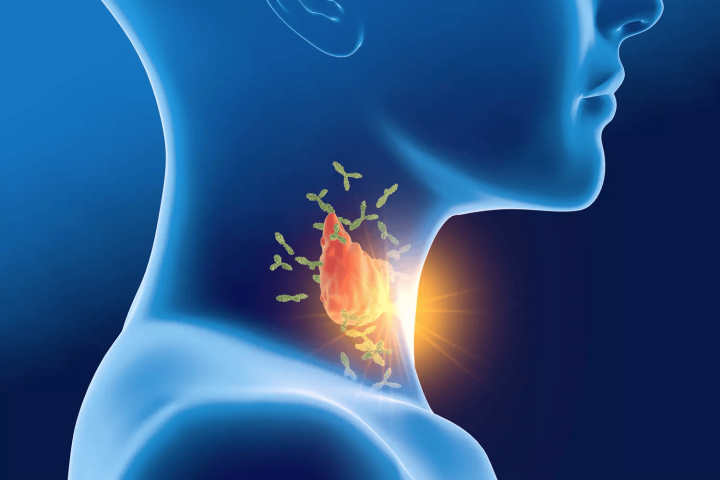 Exclusivité : l’hypothyroïdie et la grande mise au point de JAMA - Sciences & Santé -
                    Luxe radio
