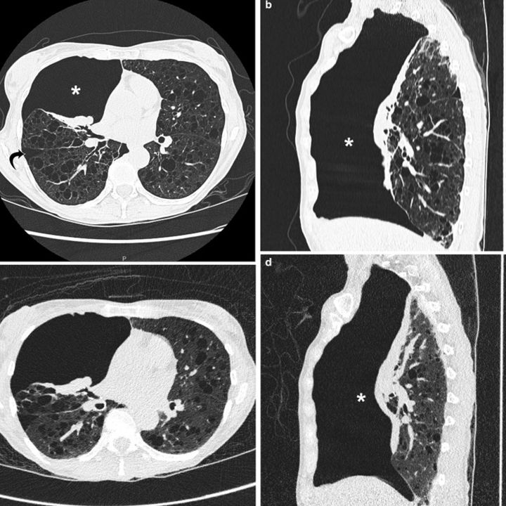 Nouvelle étude du NEJM: Match entre deux méthodes de biopsie pulmonaire - Sciences & Santé -
                    Luxe radio