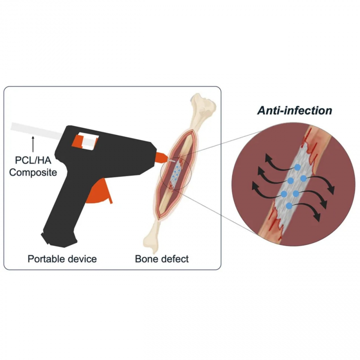 Chirurgie osseuse : un pistolet à colle transformé en imprimante 3D - Sciences & Santé -
                    Luxe radio