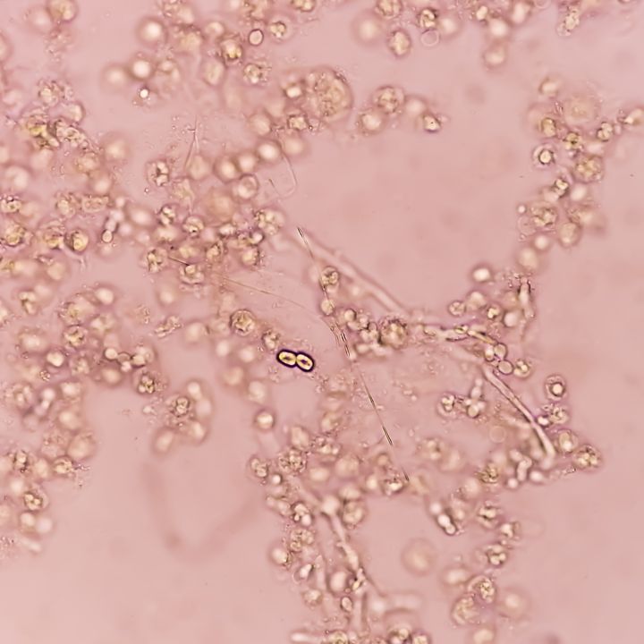 Un champignon intestinal contre la maladie du foie: l’espoir venu de Fusarium foetens - Sciences & Santé -
                    Luxe radio