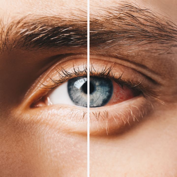 L’uvéite, une urgence qui menace la vue - Avec Ou Sans Parure -
                    Luxe radio